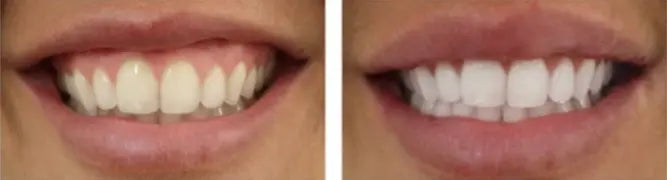 Set pentru inalbirea Dintilor !