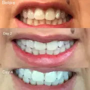 Set pentru inalbirea Dintilor !